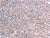 The image on the left is immunohistochemistry of paraffin-embedded Human liver cancer tissue using CSB-PA617153 (RELA Antibody) at dilution 1/25, on the right is treated with fusion protein. (Original magnification: ×200)