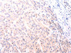 The image on the left is immunohistochemistry of paraffin-embedded Human esophagus cancer tissue using CSB-PA439037 (NFKBIE Antibody) at dilution 1/25, on the right is treated with fusion protein. (Original magnification: ×200) The image on the left is immunohistochemistry of paraffin-embedded Human esophagus cancer tissue using CSB-PA439037 (NFKBIE Antibody) at dilution 1/25, on the right is treated with fusion protein. (Original magnification: ×200)