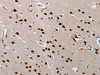 The image on the left is immunohistochemistry of paraffin-embedded Human brain tissue using CSB-PA286755 (TONSL Antibody) at dilution 1/60, on the right is treated with fusion protein. (Original magnification: ×200) The image on the left is immunohistochemistry of paraffin-embedded Human brain tissue using CSB-PA286755 (TONSL Antibody) at dilution 1/60, on the right is treated with fusion protein. (Original magnification: ×200)
