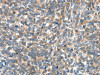 The image on the left is immunohistochemistry of paraffin-embedded Human ovarian cancer tissue using CSB-PA588410 (EIF4EBP1 Antibody) at dilution 1/30, on the right is treated with fusion protein. (Original magnification: ×200)