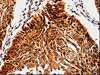 The image is immunohistochemistry of paraffin-embedded Human cervical cancer tissue using CSB-PA181054 (ABCB5 Antibody) at dilution 1/10. (Original magnification: ×200)