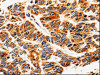 The image on the left is immunohistochemistry of paraffin-embedded Human lung cancer tissue using CSB-PA967715 (ABCB5 Antibody) at dilution 1/10, on the right is treated with fusion protein. (Original magnification: ×200)