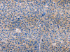 The image on the left is immunohistochemistry of paraffin-embedded Human liver cancer tissue using CSB-PA248410 (AMACR Antibody) at dilution 1/30, on the right is treated with fusion protein. (Original magnification: ×200)