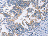 The image on the left is immunohistochemistry of paraffin-embedded Human gastric cancer tissue using CSB-PA248410 (AMACR Antibody) at dilution 1/30, on the right is treated with fusion protein. (Original magnification: ×200)