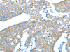 The image on the left is immunohistochemistry of paraffin-embedded Human breast cancer tissue using CSB-PA068489 (AMPH Antibody) at dilution 1/25, on the right is treated with fusion protein. (Original magnification: ×200)