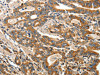 The image on the left is immunohistochemistry of paraffin-embedded Human gastic cancer tissue using CSB-PA601738 (ANGPTL1 Antibody) at dilution 1/40, on the right is treated with fusion protein. (Original magnification: ×200)