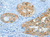 The image on the left is immunohistochemistry of paraffin-embedded Human cervical cancer tissue using CSB-PA556717 (ANXA3 Antibody) at dilution 1/25, on the right is treated with fusion protein. (Original magnification: ×200)