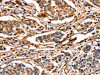 The image on the left is immunohistochemistry of paraffin-embedded Human breast cancer tissue using CSB-PA197126 (ANXA6 Antibody) at dilution 1/17, on the right is treated with fusion protein. (Original magnification: ×200)