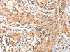The image on the left is immunohistochemistry of paraffin-embedded Human lung cancer tissue using CSB-PA944795 (ANXA8 Antibody) at dilution 1/25, on the right is treated with fusion protein. (Original magnification: ×200)
