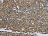 The image on the left is immunohistochemistry of paraffin-embedded Human ovarian cancer tissue using CSB-PA002912 (KRT5 Antibody) at dilution 1/30, on the right is treated with fusion protein. (Original magnification: ×200)