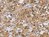The image on the left is immunohistochemistry of paraffin-embedded Human thyroid cancer tissue using CSB-PA002912 (KRT5 Antibody) at dilution 1/30, on the right is treated with fusion protein. (Original magnification: ×200)