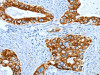 The image on the left is immunohistochemistry of paraffin-embedded Human cervical cancer tissue using CSB-PA268168 (KRT40 Antibody) at dilution 1/50, on the right is treated with fusion protein. (Original magnification: ×200)