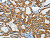 The image on the left is immunohistochemistry of paraffin-embedded Human thyroid cancer tissue using CSB-PA268168 (KRT40 Antibody) at dilution 1/50, on the right is treated with fusion protein. (Original magnification: ×200)