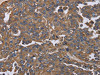 The image on the left is immunohistochemistry of paraffin-embedded Human ovarian cancer tissue using CSB-PA438776 (KRT31 Antibody) at dilution 1/20, on the right is treated with fusion protein. (Original magnification: ×200)