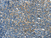 The image on the left is immunohistochemistry of paraffin-embedded Human ovarian cancer tissue using CSB-PA182867 (FSCN1 Antibody) at dilution 1/20, on the right is treated with fusion protein. (Original magnification: ×200)