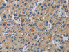 The image is immunohistochemistry of paraffin-embedded Human liver cancer tissue using CSB-PA079169 (SAR1B Antibody) at dilution 1/20. (Original magnification: ×200)