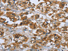 The image on the left is immunohistochemistry of paraffin-embedded Human thyroid cancer tissue using CSB-PA841145 (RAP1B Antibody) at dilution 1/50, on the right is treated with fusion protein. (Original magnification: ×200)