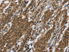 The image on the left is immunohistochemistry of paraffin-embedded Human gastric cancer tissue using CSB-PA841145 (RAP1B Antibody) at dilution 1/50, on the right is treated with fusion protein. (Original magnification: ×200)