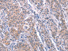 The image on the left is immunohistochemistry of paraffin-embedded Human gastric cancer tissue using CSB-PA786870 (ARC Antibody) at dilution 1/25, on the right is treated with fusion protein. (Original magnification: ×200)