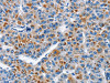 The image on the left is immunohistochemistry of paraffin-embedded Human liver cancer tissue using CSB-PA038092 (ATF4 Antibody) at dilution 1/40, on the right is treated with fusion protein. (Original magnification: ×200)