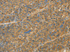 The image on the left is immunohistochemistry of paraffin-embedded Human liver cancer tissue using CSB-PA981923 (TNFSF13B Antibody) at dilution 1/20, on the right is treated with fusion protein. (Original magnification: ×200) The image on the left is immunohistochemistry of paraffin-embedded Human liver cancer tissue using CSB-PA981923 (TNFSF13B Antibody) at dilution 1/20, on the right is treated with fusion protein. (Original magnification: ×200)