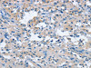 The image on the left is immunohistochemistry of paraffin-embedded Human thyroid cancer tissue using CSB-PA215086 (FGF9 Antibody) at dilution 1/25, on the right is treated with fusion protein. (Original magnification: ×200)