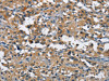 The image on the left is immunohistochemistry of paraffin-embedded Human thyroid cancer tissue using CSB-PA698112 (BMPR1B Antibody) at dilution 1/25, on the right is treated with fusion protein. (Original magnification: ×200)