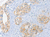 The image on the left is immunohistochemistry of paraffin-embedded Human cervical cancer tissue using CSB-PA291937 (BRCA1 Antibody) at dilution 1/35, on the right is treated with fusion protein. (Original magnification: ×200)