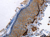 The image on the left is immunohistochemistry of paraffin-embedded Human skin tissue using CSB-PA437587 (CALD1 Antibody) at dilution 1/40, on the right is treated with fusion protein. (Original magnification: ×200)