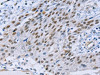 The image on the left is immunohistochemistry of paraffin-embedded Human esophagus cancer tissue using CSB-PA559356 (CAPN6 Antibody) at dilution 1/15, on the right is treated with fusion protein. (Original magnification: ×200)