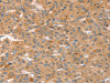 The image on the left is immunohistochemistry of paraffin-embedded Human liver cancer tissue using CSB-PA346002 (CAPN7 Antibody) at dilution 1/20, on the right is treated with fusion protein. (Original magnification: ×200)