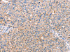 The image on the left is immunohistochemistry of paraffin-embedded Human breast cancer tissue using CSB-PA346002 (CAPN7 Antibody) at dilution 1/20, on the right is treated with fusion protein. (Original magnification: ×200)