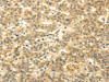 The image on the left is immunohistochemistry of paraffin-embedded Human liver cancer tissue using CSB-PA783286 (CAMK1G Antibody) at dilution 1/20, on the right is treated with fusion protein. (Original magnification: ×200)