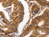 The image on the left is immunohistochemistry of paraffin-embedded Human colon cancer tissue using CSB-PA257327 (CA2 Antibody) at dilution 1/20, on the right is treated with fusion protein. (Original magnification: ×200)