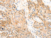 The image on the left is immunohistochemistry of paraffin-embedded Human esophagus cancer tissue using CSB-PA257327 (CA2 Antibody) at dilution 1/20, on the right is treated with fusion protein. (Original magnification: ×200)