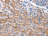 The image on the left is immunohistochemistry of paraffin-embedded Human liver cancer tissue using CSB-PA280305 (CDK5 Antibody) at dilution 1/10, on the right is treated with fusion protein. (Original magnification: ×200)