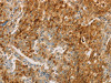 The image on the left is immunohistochemistry of paraffin-embedded Human gastic cancer tissue using CSB-PA077200 (CEACAM8 Antibody) at dilution 1/30, on the right is treated with fusion protein. (Original magnification: ×200)