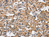 The image on the left is immunohistochemistry of paraffin-embedded Human thyroid cancer tissue using CSB-PA055165 (CEACAM3 Antibody) at dilution 1/70, on the right is treated with fusion protein. (Original magnification: ×200)