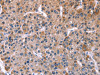 The image on the left is immunohistochemistry of paraffin-embedded Human liver cancer tissue using CSB-PA576885 (CHRM1 Antibody) at dilution 1/20, on the right is treated with fusion protein. (Original magnification: ×200)