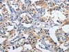The image on the left is immunohistochemistry of paraffin-embedded Human thyroid cancer tissue using CSB-PA114834 (CLEC2D Antibody) at dilution 1/60, on the right is treated with fusion protein. (Original magnification: ×200)