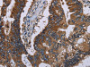 The image on the left is immunohistochemistry of paraffin-embedded Human colon cancer tissue using CSB-PA144936 (CLDND1 Antibody) at dilution 1/40, on the right is treated with fusion protein. (Original magnification: ×200) The image on the left is immunohistochemistry of paraffin-embedded Human colon cancer tissue using CSB-PA144936 (CLDND1 Antibody) at dilution 1/40, on the right is treated with fusion protein. (Original magnification: ×200)