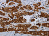 The image on the left is immunohistochemistry of paraffin-embedded Human breast cancer tissue using CSB-PA127808 (COX6B2 Antibody) at dilution 1/35, on the right is treated with fusion protein. (Original magnification: ×200)