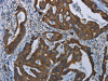 The image on the left is immunohistochemistry of paraffin-embedded Human gastric cancer tissue using CSB-PA127808 (COX6B2 Antibody) at dilution 1/35, on the right is treated with fusion protein. (Original magnification: ×200)