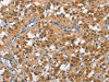 The image on the left is immunohistochemistry of paraffin-embedded Human thyroid cancer tissue using CSB-PA103046 (CUL7 Antibody) at dilution 1/50, on the right is treated with fusion protein. (Original magnification: ×200)