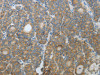 The image on the left is immunohistochemistry of paraffin-embedded Human thyroid cancer tissue using CSB-PA989223 (CXCR3 Antibody) at dilution 1/20, on the right is treated with fusion protein. (Original magnification: ×200)