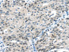 The image on the left is immunohistochemistry of paraffin-embedded Human breast cancer tissue using CSB-PA078687 (CCNA1 Antibody) at dilution 1/20, on the right is treated with fusion protein. (Original magnification: ×200)