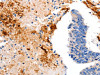 The image on the left is immunohistochemistry of paraffin-embedded Human colon cancer tissue using CSB-PA619982 (CCNC Antibody) at dilution 1/15, on the right is treated with fusion protein. (Original magnification: ×200)