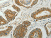 The image on the left is immunohistochemistry of paraffin-embedded Human colon cancer tissue using CSB-PA516472 (CCND1 Antibody) at dilution 1/50, on the right is treated with fusion protein. (Original magnification: ×200)