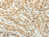 The image on the left is immunohistochemistry of paraffin-embedded Human lung cancer tissue using CSB-PA516472 (CCND1 Antibody) at dilution 1/50, on the right is treated with fusion protein. (Original magnification: ×200)