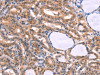 The image on the left is immunohistochemistry of paraffin-embedded Human thyroid cancer tissue using CSB-PA078505 (CYP1B1 Antibody) at dilution 1/20, on the right is treated with fusion protein. (Original magnification: ×200)